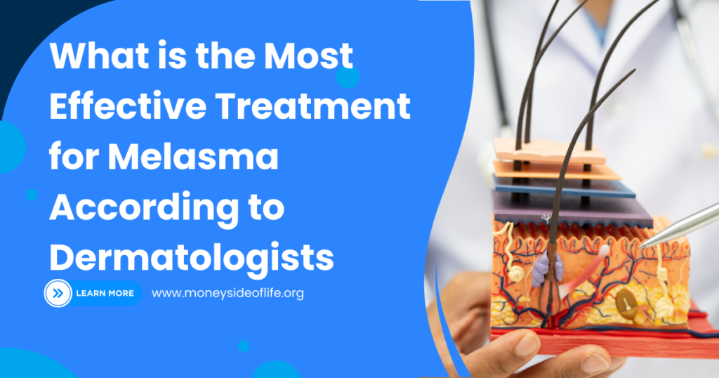 What is the Most Effective Treatment for Melasma According to Dermatologists